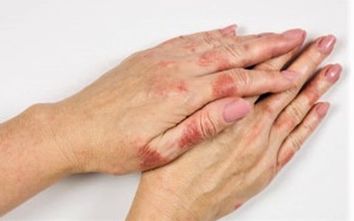 El egzaması ve Covid Prof. Dr. Ayşe Tülin Güleç Dermatoloji Uzmanı